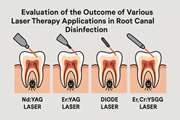 Evaluation of the outcome of various laser therapy applications in root canal disinfection: A systematic review