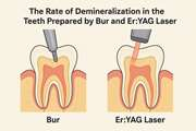 The Rate of Demineralization in the Teeth Prepared by Bur and Er:YAG Laser
