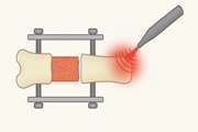 The Effect of Photobiomodulation on Distraction Osteogenesis