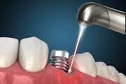 In Vitro Efficacy of Antimicrobial Photodynamic Therapy With Phycocyanin and Diode Laser for the Reduction of Porphyromonas gingivalis