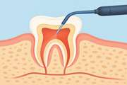 Can Antimicrobial Photodynamic Therapy (aPDT) Enhance the Endodontic Treatment?
