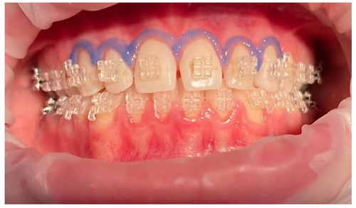 Laser-Aided Ceramic Bracket Debonding: A Comprehensive Review