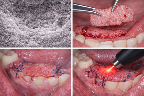 All done procedure by laser in free gingival graft treatment: A case series study
